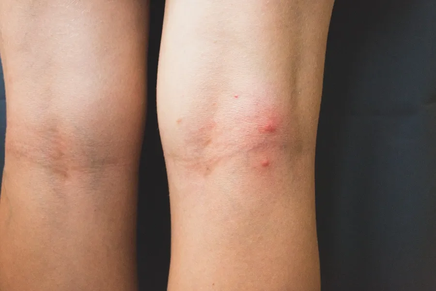 Close-up of red, raised bug bites clustered on human skin behind the knee