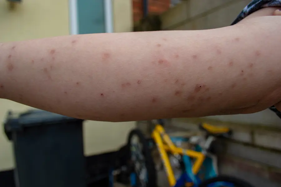Bed bug bites on a person's arm