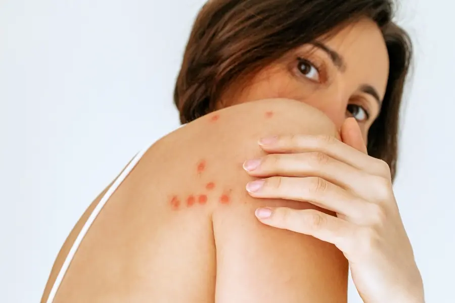 Woman looking over her shoulder showing red, itchy insect bite marks on her upper arm and shoulder