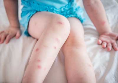 Bed bug bites on child's leg